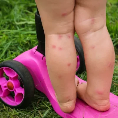 Bebe-con-alergia-en-las-piernas